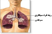 دکتر محمدرضا زاهدپورانارکی فوق تخصص ریه