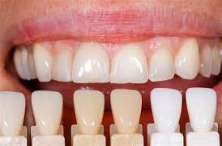 مراحل ترمیم لمینیت دندان | مراحل ترمیم کامپوزیت ونیر| بهترین دندانپزشک زیبایی